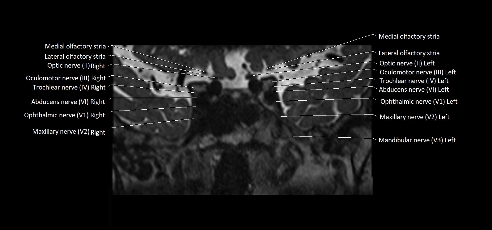 Cranial nerve cross sectional anatomy coronal 3T MRI image 24.webp